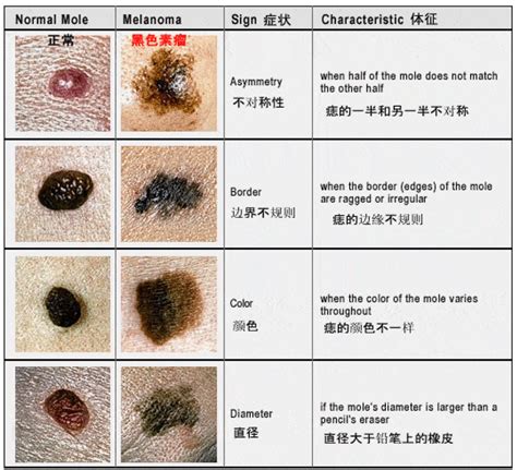 黑色痣|痣也可能会癌变！长在 3 个地方要注意